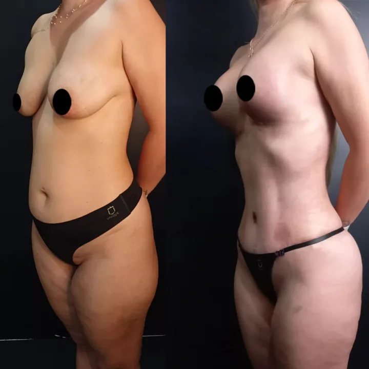 Antes e Depois
