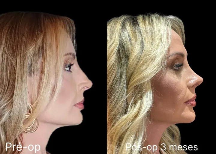 Antes e Depois